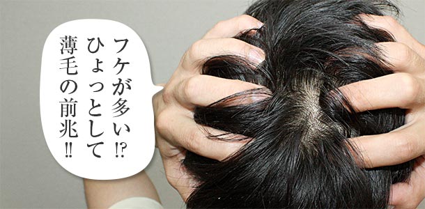 フケが多いのは薄毛の前兆